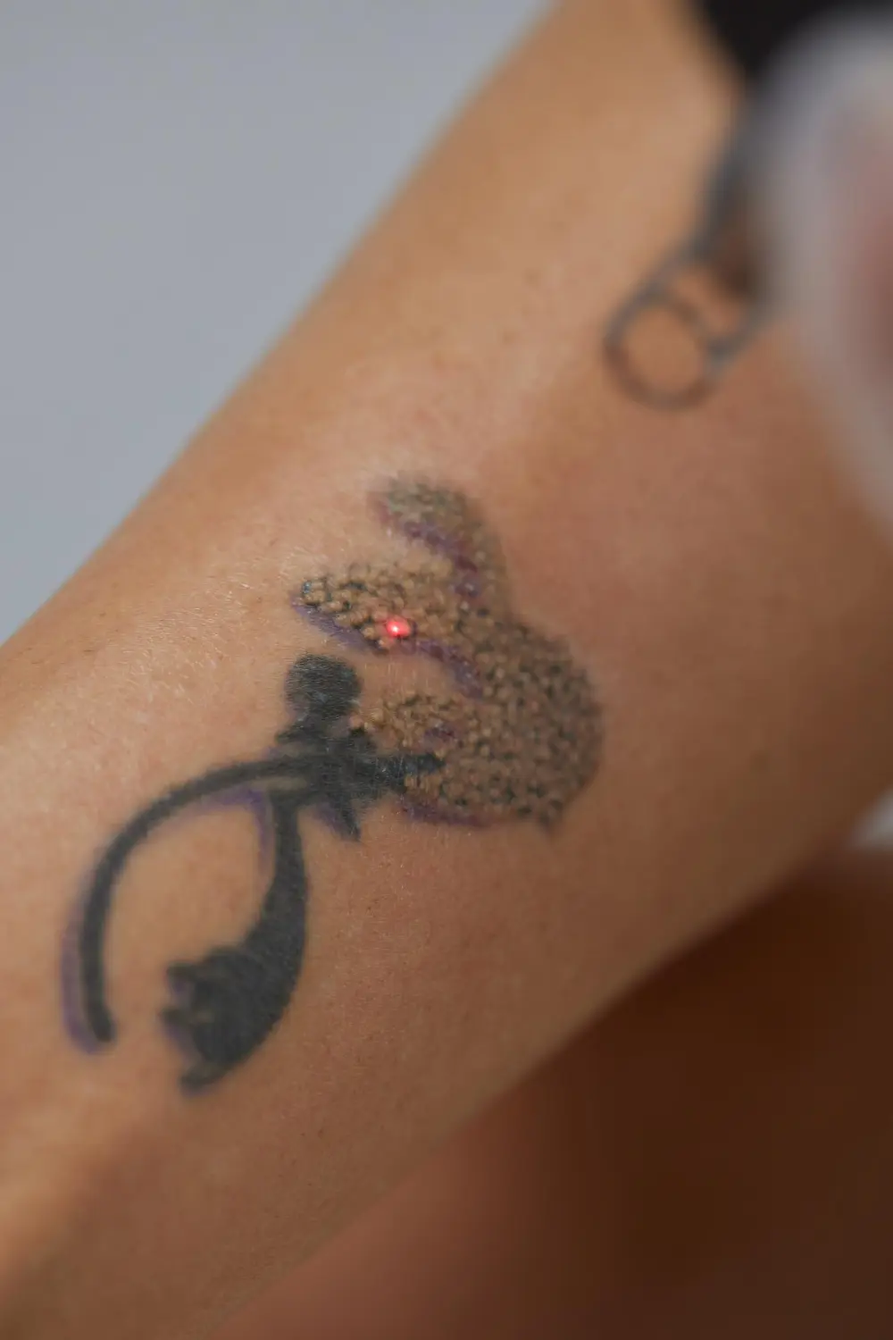 Retiro de tatuajes